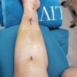 Left Leg After Surgery at blue towels June 15