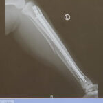 Xray of Left Leg June 15 2020