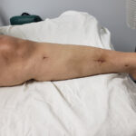 Week 6 Left Leg with Herbs and Treatment July 8