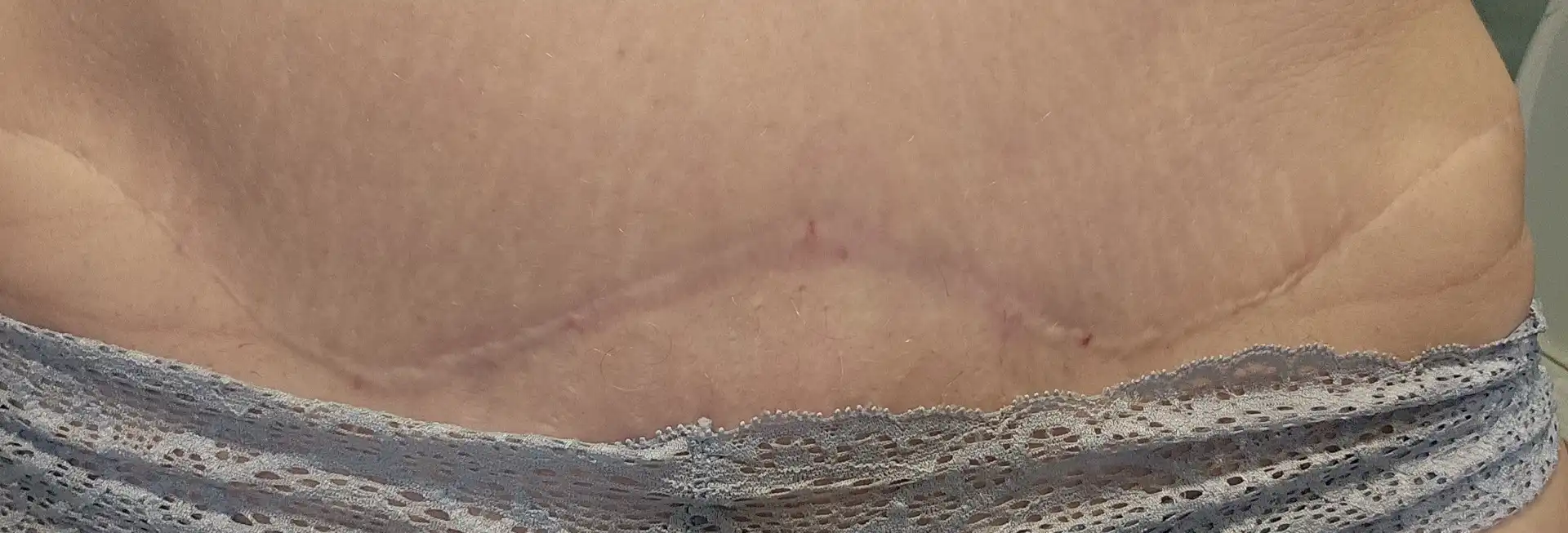 AIT One 1 week after treatment AIT One 1 week after treatment