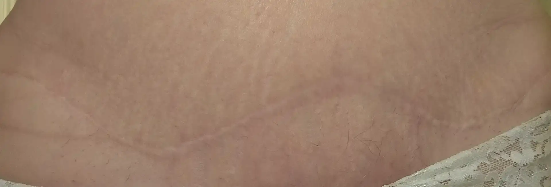 AIT 3 months after treatment AIT 3 months after treatment