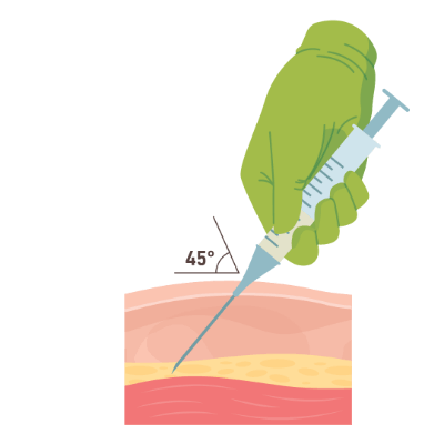 Subcutaneously or under the skin layer