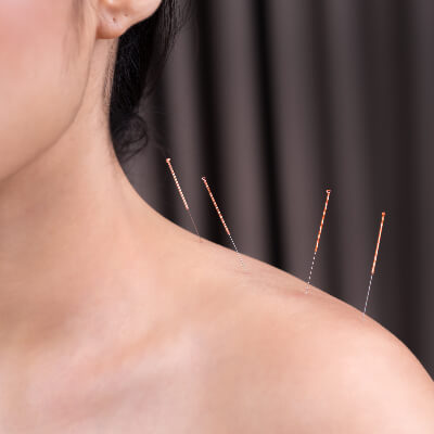 Ready to try acupuncture for the first time?
